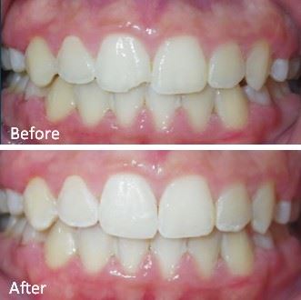 Anterior Resin Photo